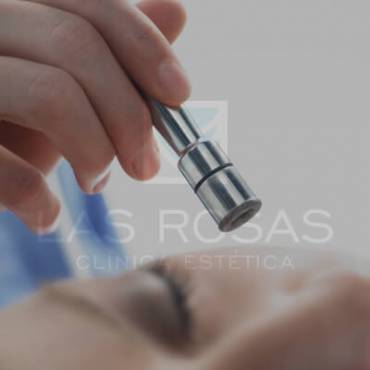 Microdermoabrasión con punta de diamante