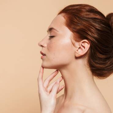 Profhilo – Ácido Hialurónico